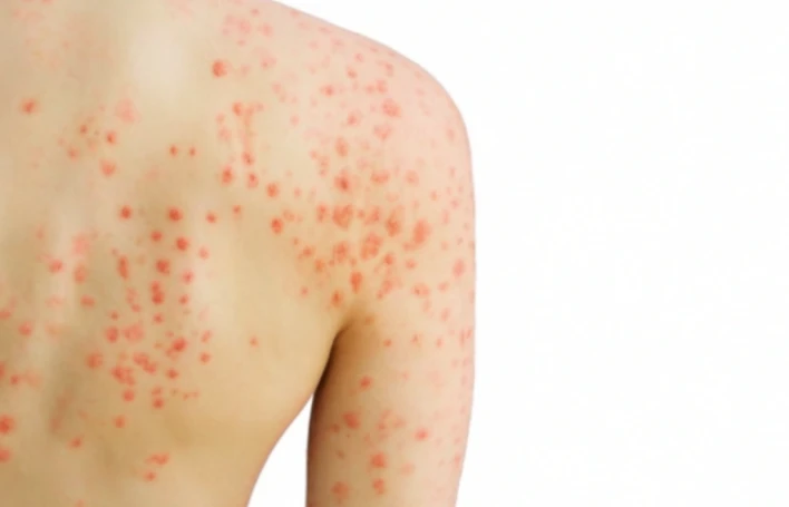 Psoriasis: symptoms, causes, treatment & care