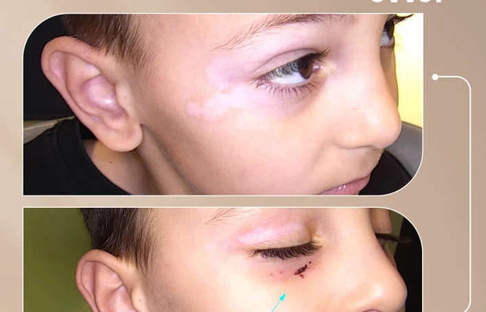 Vitiliqo müalicəsi Bakıda — Kani Dəri Clinic