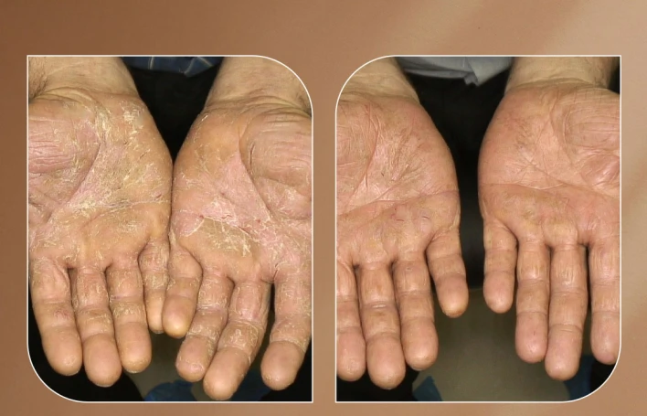 Bakıda psoriazın müalicəsi — Kani Dəri Clinic