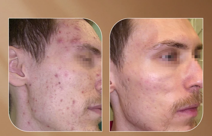 Bakıda akne (sızanaq) müalicəsi — Kani Dəri Clinic