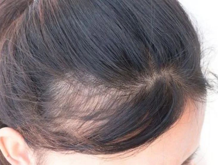 androgen-alopesiya-ru